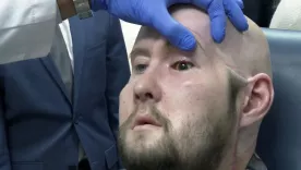 trasplante de ojo completo
