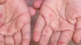 Afectación por virus Coxsackie o Enterovirus A71